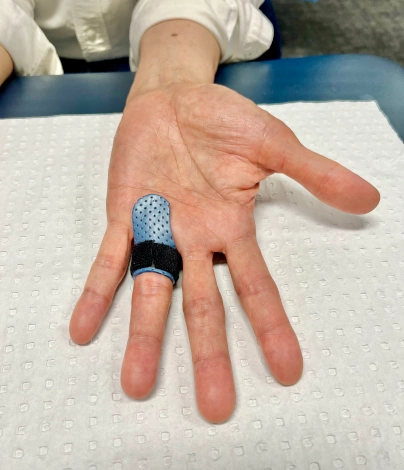 Conservative-Trigger-Finger-Treatment-Splint