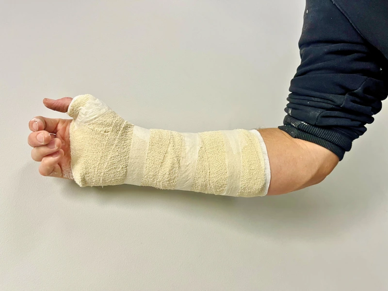 Hand Fracture In Plaster Hand Therapy Experts