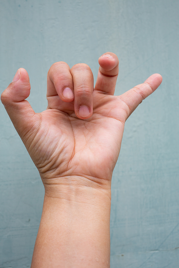 Trigger Finger Lock On Fingers Of Woman's Front Left Hand, Suffe
