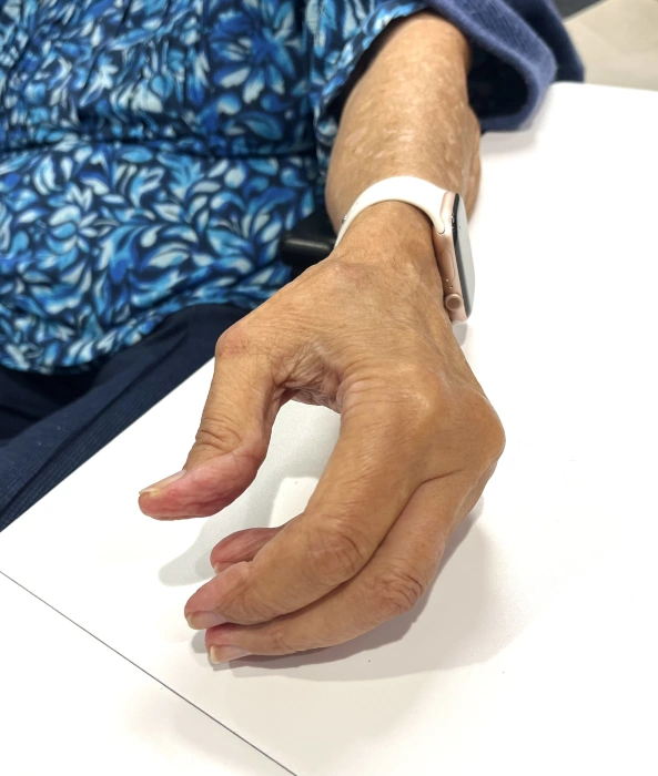 thumb-arthritis-deformity