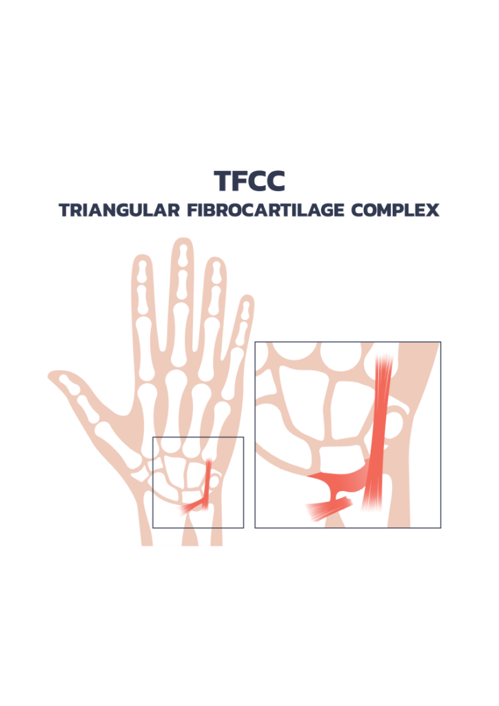 TFCC - Triangular Fibrocartilage Complex - Anatomy