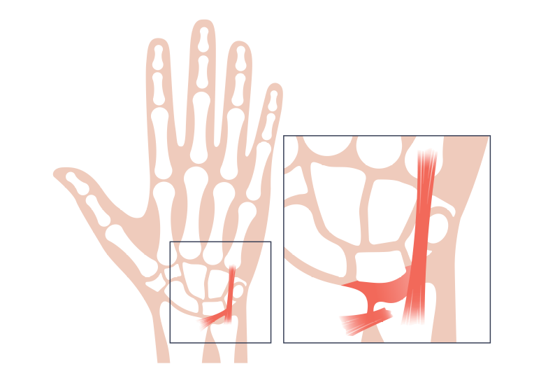 TFCC - Triangular Fibrocartilage Complex - Anatomy