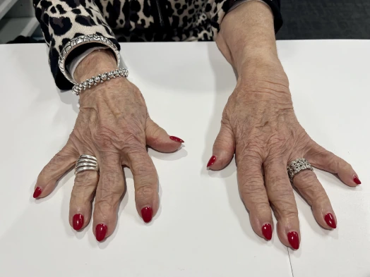 Thumb and finger arthritis deformities